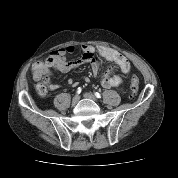Autosomal dominant polycystic kidney disease (Radiopaedia 27851-28094 B 92).jpg