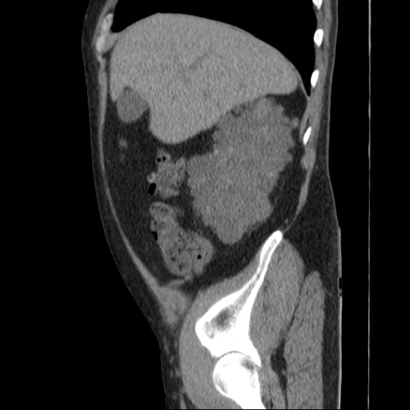 File:Autosomal dominant polycystic kidney disease (Radiopaedia 36539-38101 D 20).jpg