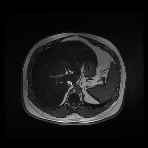 Autosomal dominant polycystic kidney disease (Radiopaedia 50259-55611 Axial 2D Dual Echo 27).jpg