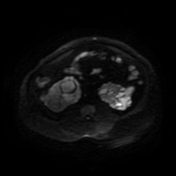 Autosomal dominant polycystic kidney disease (Radiopaedia 50259-55611 Axial DWI 66).jpg