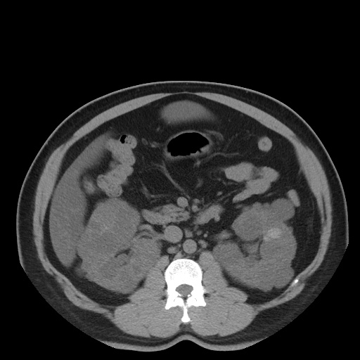 Autosomal dominant polycystic kidney disease (Radiopaedia 50259-55612 Axial non-contrast 37).jpg
