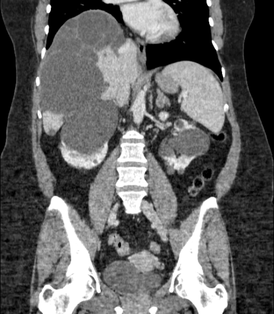 Autosomal dominant polycystic kidney disease (Radiopaedia 57124-64017 B 45).jpg