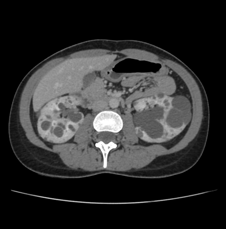 Autosomal dominant polycystic kidney disease - early onset (Radiopaedia 40734-43387 A 37).jpg