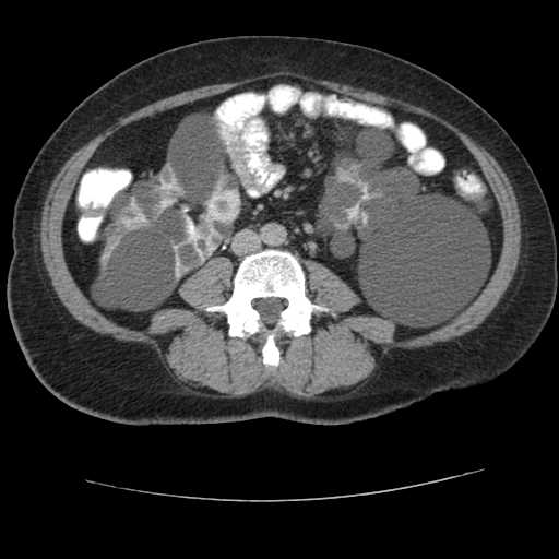 File:Autosomal dominant polycystic kidney disease with hepatic involvement (Radiopaedia 32693-33662 C 47).jpg