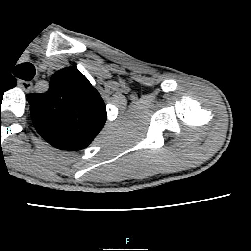 Avascular necrosis after fracture dislocations of the proximal humerus (Radiopaedia 88078-104653 D 31).jpg