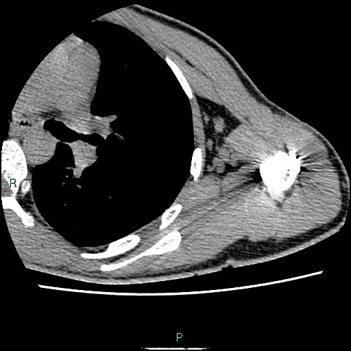 File:Avascular necrosis after fracture dislocations of the proximal humerus (Radiopaedia 88078-104653 D 67).jpg