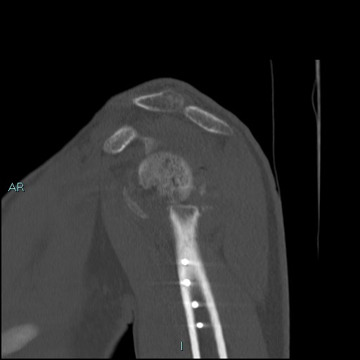 Avascular necrosis after fracture dislocations of the proximal humerus (Radiopaedia 88078-104653 Sagittal bone window 30).jpg