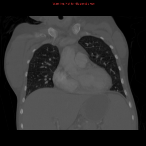 File:Avascular necrosis in sickle cell disease (Radiopaedia 17448-17152 Coronal bone window 46).jpg