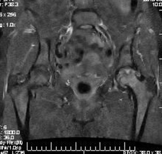 File:Avascular necrosis of hip (Radiopaedia 10061-10601 Coronal STIR 1).jpg