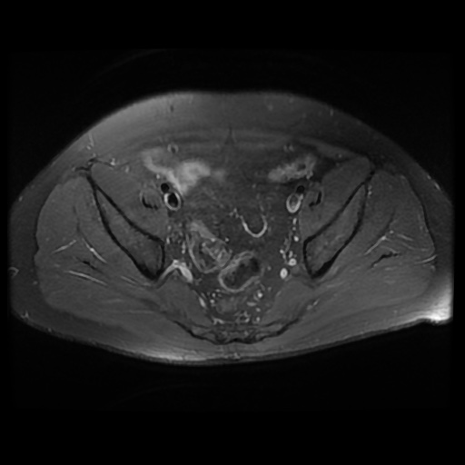 File:Avascular necrosis of the hip (Radiopaedia 61503-69465 Axial PD fat sat 9).jpg