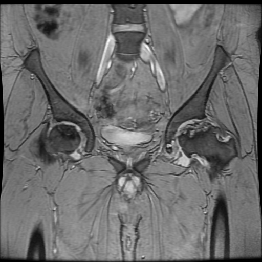Avascular necrosis of the hip (Radiopaedia 61503-69465 F 36).jpg