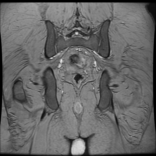 Avascular necrosis of the hip (Radiopaedia 61503-69465 F 81).jpg