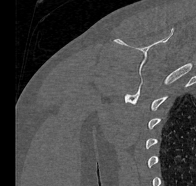 Avulsion fracture - greater tuberosity of humerus (Radiopaedia 71216-81514 Coronal bone window 63).jpg