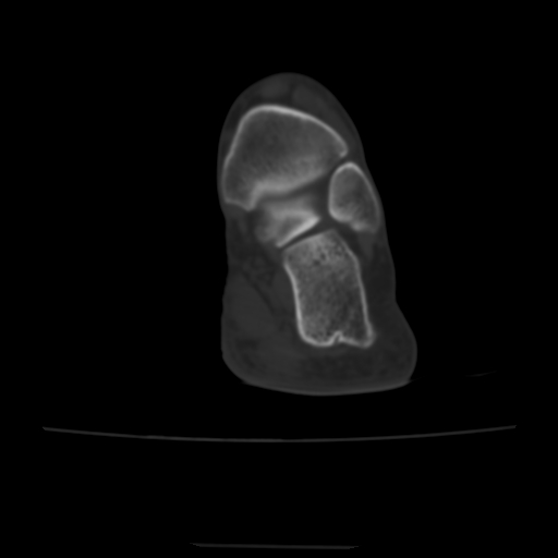 Avulsion fracture of the dorsal cuboid bone (Radiopaedia 51586-57377 Axial bone window 7).jpg