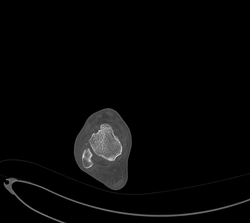 Avulsion fractures of talus and calcaneus (Radiopaedia 48277-53155 Axial bone window 16).jpg