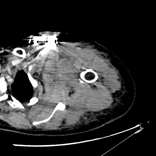 File:Axillary arterial pseudoaneurysm (Radiopaedia 24925-25195 A 3).jpg