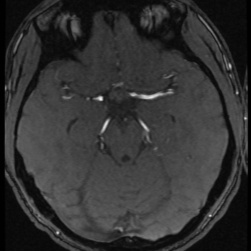File:Azygos anterior cerebral artery (Radiopaedia 17059-16756 Axial MRA 43).jpg