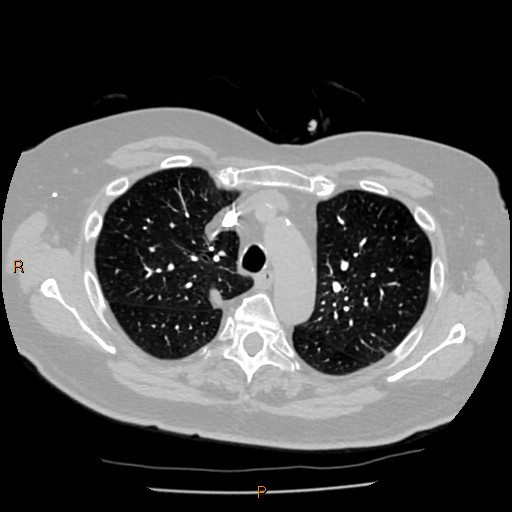 Azygos lobe (Radiopaedia 40161-42821 Axial lung window 17).jpg