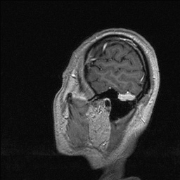 Balo concentric sclerosis (Radiopaedia 50458-55940 Sagittal T1 C+ 134).jpg