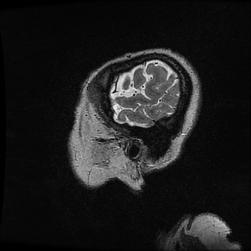 Balo concentric sclerosis (Radiopaedia 53875-59982 Sagittal 3D FSE 270).jpg