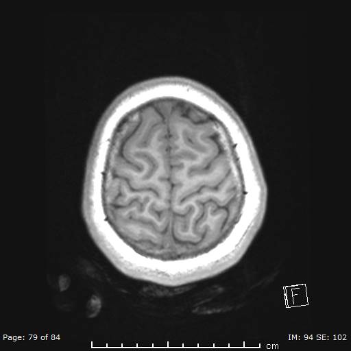 Balo concentric sclerosis (Radiopaedia 61637-69636 Axial T1 79).jpg