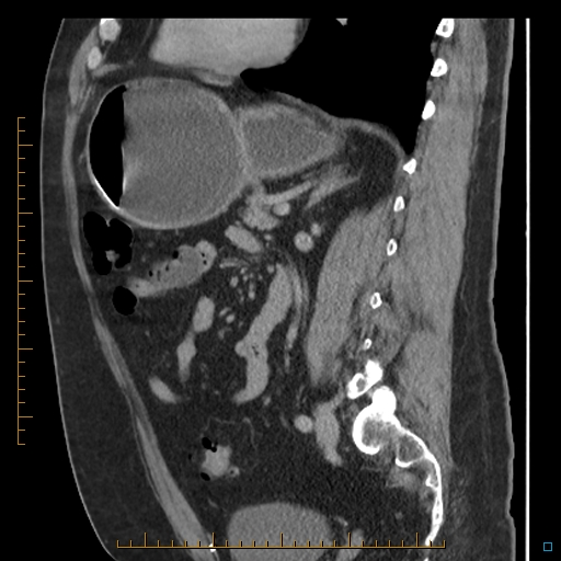 File:Bariatric balloon causing gastric outlet obstruction (Radiopaedia 54449-60672 C 34).jpg