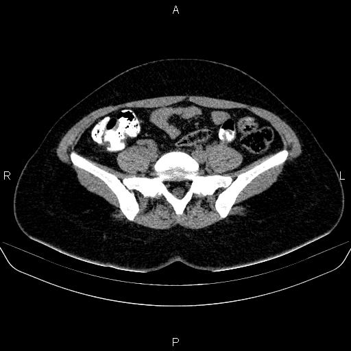 Bartholin gland cyst (Radiopaedia 62635-70930 Axial non-contrast 13).jpg