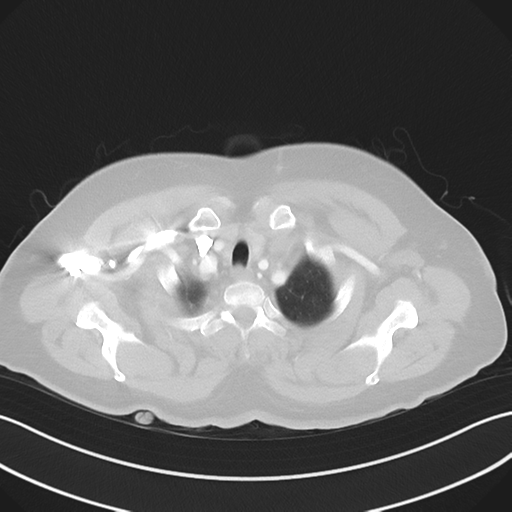 Basal ganglia metastasis (Radiopaedia 78928-91832 B 6).png
