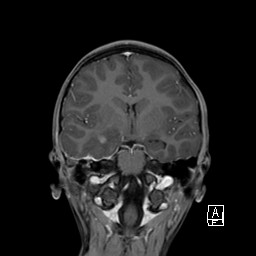 Base of skull rhabdomyosarcoma (Radiopaedia 32196-33142 I 39).jpg