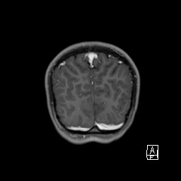 File:Base of skull rhabdomyosarcoma (Radiopaedia 32196-33142 I 63).jpg