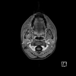 Base of skull rhabdomyosarcoma (Radiopaedia 32196-33142 T1 C+ fat sat 14).jpg
