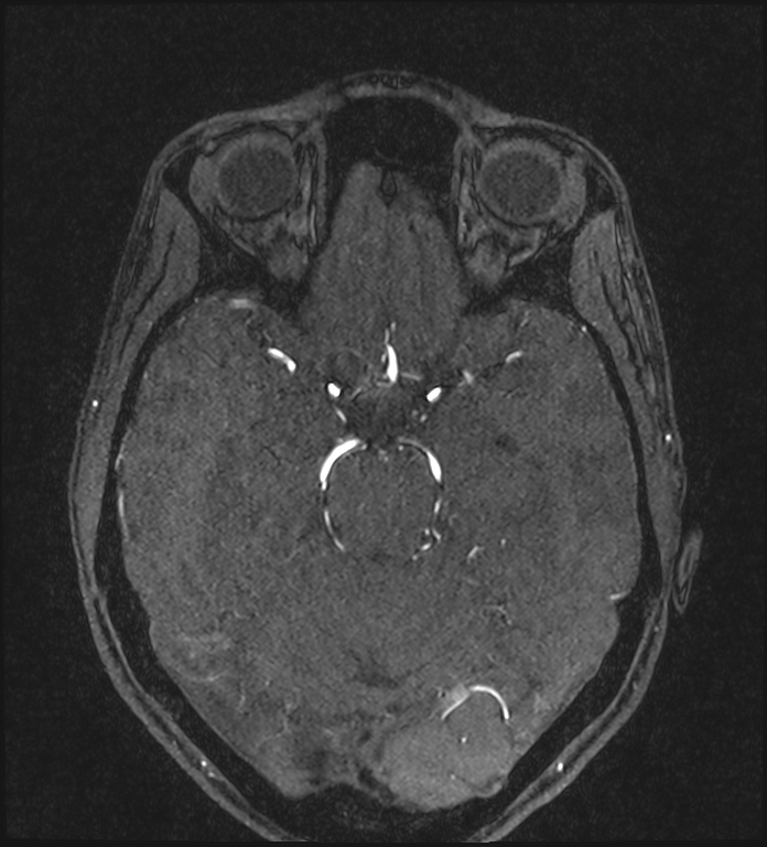 Basilar artery perforator aneurysm (Radiopaedia 82455-97733 Axial MRA 98).jpg
