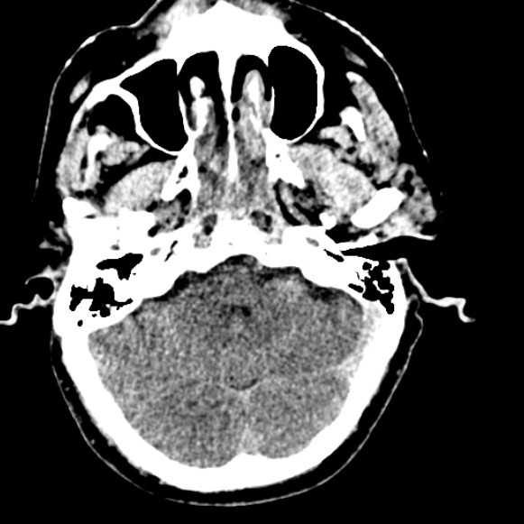 Basilar artery thrombosis (Radiopaedia 53351-59333 Axial non-contrast 37).jpg