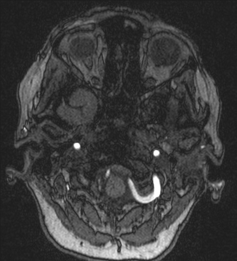 Basilar tip aneurysm (Radiopaedia 26504-26632 MRA 20).jpg