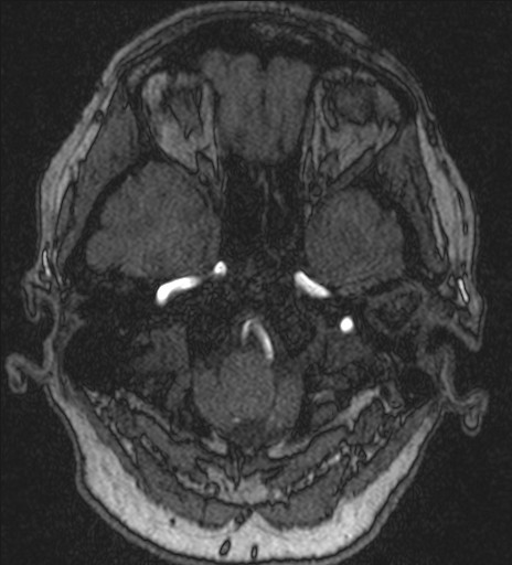Basilar tip aneurysm (Radiopaedia 26504-26632 MRA 34).jpg