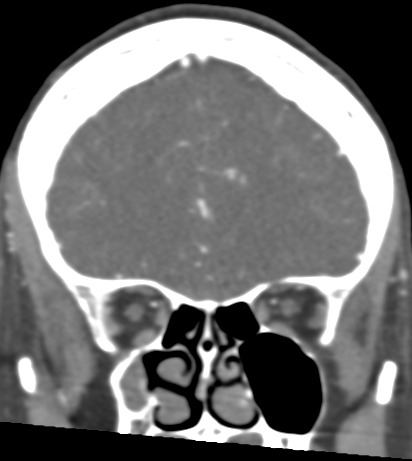 Basilar tip aneurysm with coiling (Radiopaedia 53912-60086 B 35).jpg