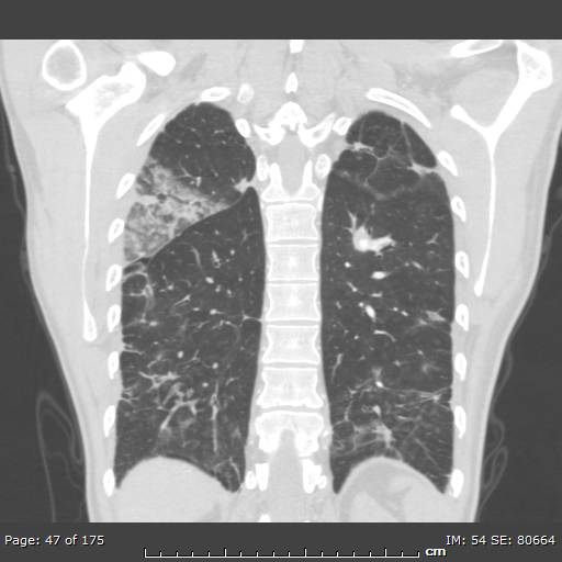 Behçet disease (Radiopaedia 44247-47889 Coronal lung window 11).jpg