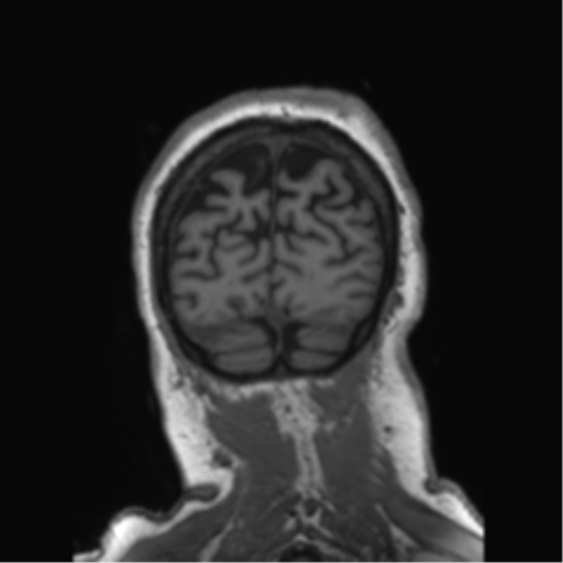Behavioral variant frontotemporal dementia and late onset schizophrenia (Radiopaedia 52197-58083 Coronal T1 20).png