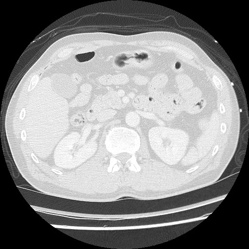 Benign post-traumatic pseudopneumoperitoneum (Radiopaedia 71199-81495 Axial lung window 78).jpg