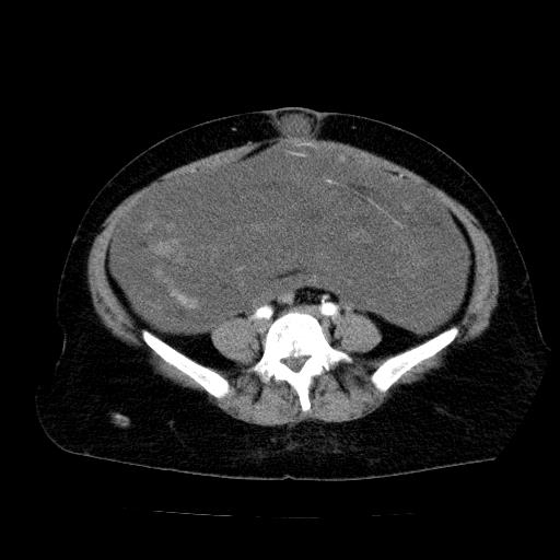 Benign spindle cell tumor - abdominopelvic (Radiopaedia 61300-69212 A 41).jpg