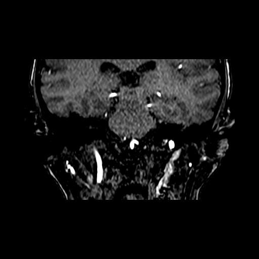 Berry aneurysm of the terminal internal carotid artery (Radiopaedia 88286-104918 Coronal TOF 62).jpg