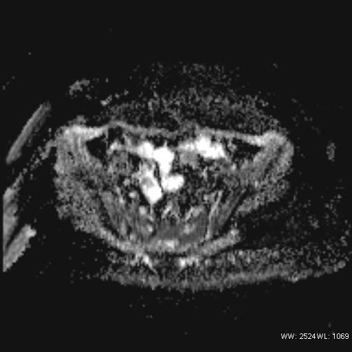 File:Bicornuate uterus- on MRI (Radiopaedia 49206-54297 Axial ADC 9).jpg
