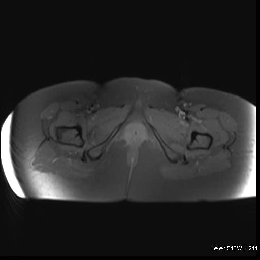 File:Bicornuate uterus- on MRI (Radiopaedia 49206-54297 Axial T1 fat sat 21).jpg