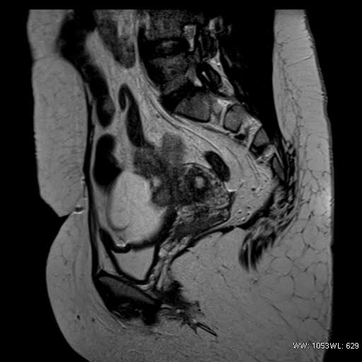 File:Bicornuate uterus- on MRI (Radiopaedia 49206-54297 Sagittal T2 17).jpg