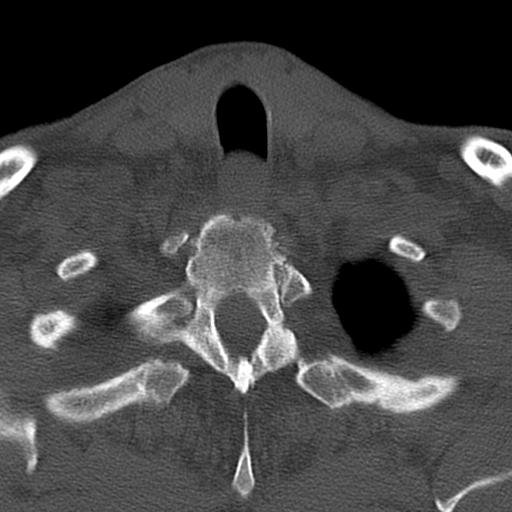 File:Bilateral C6-7 locked facet dislocation (Radiopaedia 28506-28748 Axial bone window 39).jpeg