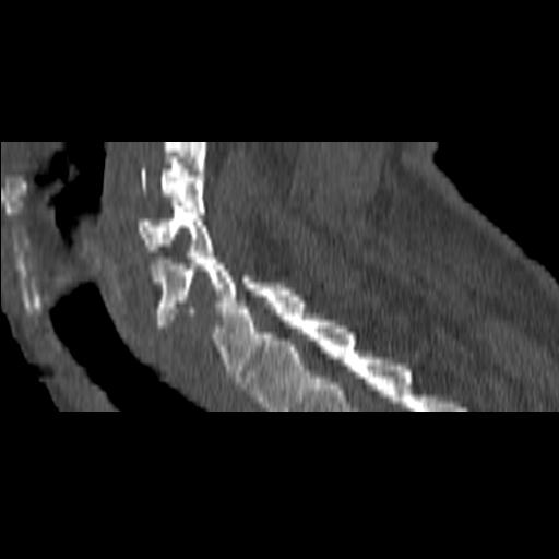 File:Bilateral C6-7 locked facet dislocation (Radiopaedia 28506-28748 Sagittal bone window 14).jpeg