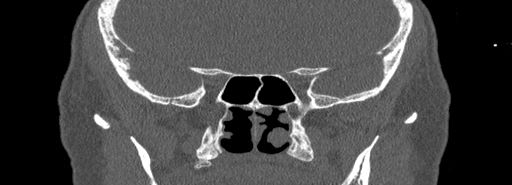 Bilateral Ectopic Infraorbital Nerves (Radiopaedia 49006-54084 Coronal bone window 64).jpg