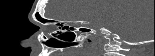 Bilateral Ectopic Infraorbital Nerves (Radiopaedia 49006-54084 Sagittal bone window 31).jpg