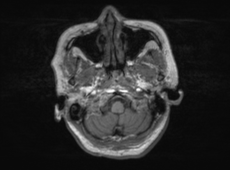 Bilateral PCA territory infarction - different ages (Radiopaedia 46200-51784 Axial T1 339).jpg