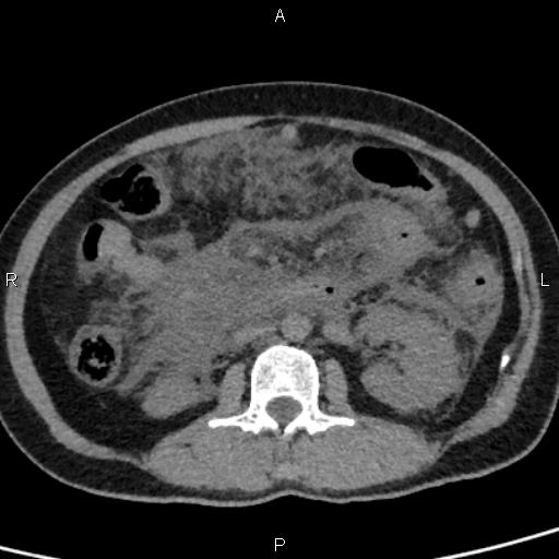 Bilateral adrenal gland hyperenhancement in pancreatitis (Radiopaedia 86642-102753 Axial non-contrast 54).jpg